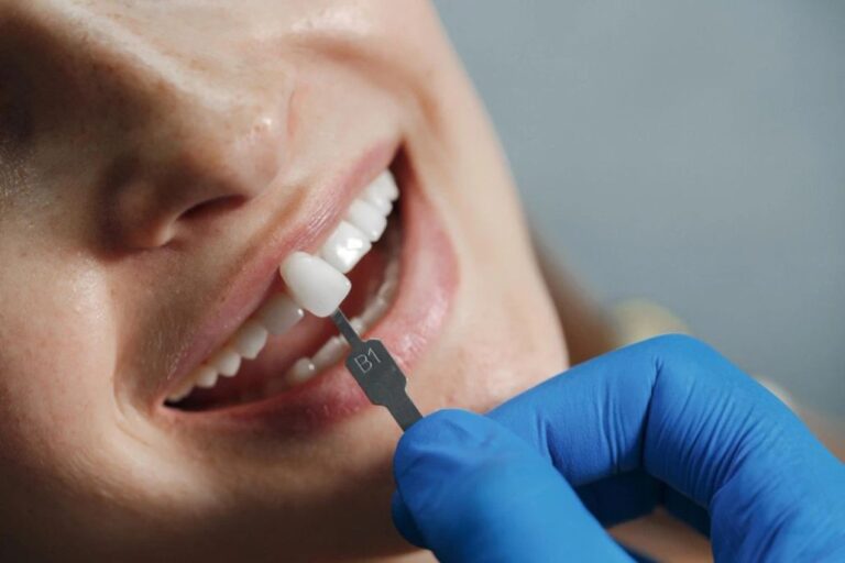 ¿Las carillas dentales en el diseño de sonrisa pueden causar mal aliento?