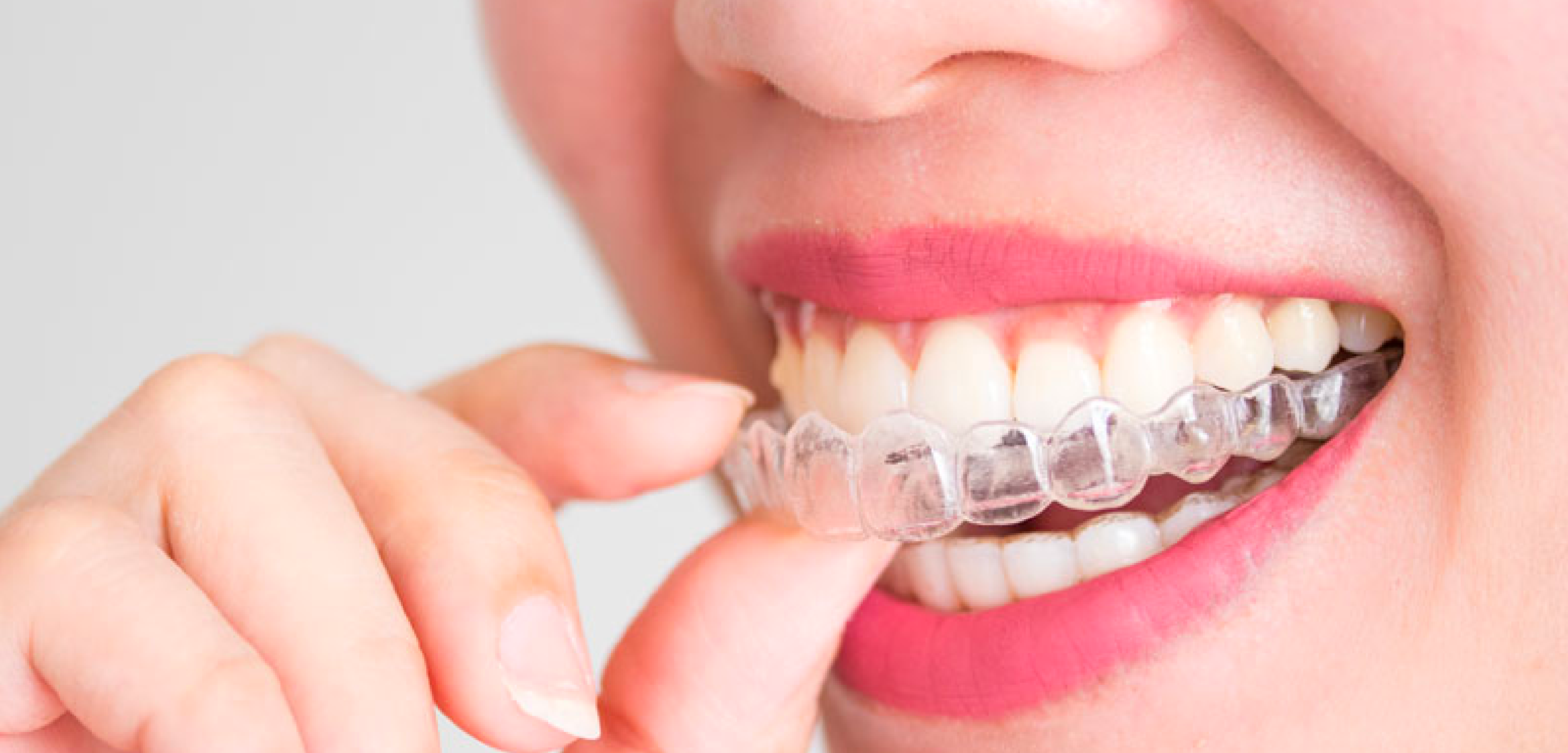 Clínicas odontológicas Sonría – Ortodoncia sin brackets