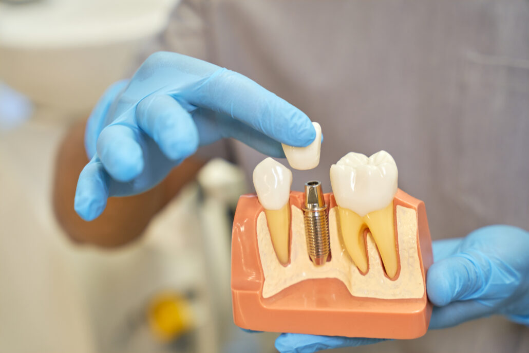Implantes dentales- Sonría