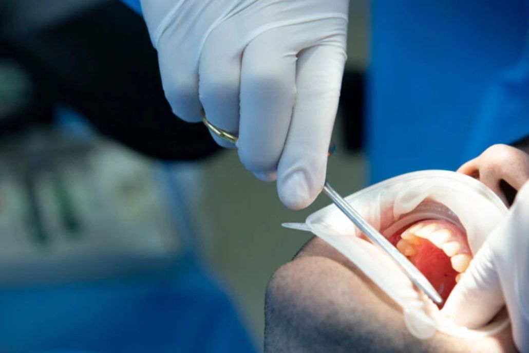 ¿Me debo extraer las cordales antes de la Ortodoncia?