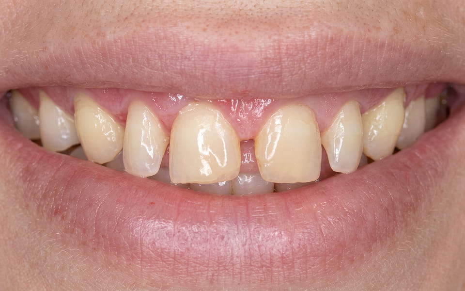 diseño-de-sonrisa-1-