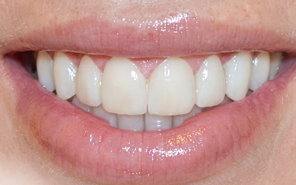 diseño-de-sonrisa-1-despues