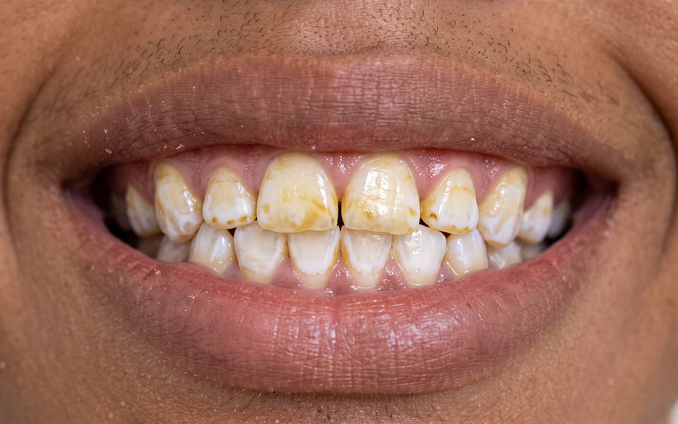 diseño-de-sonrisa-2-antes
