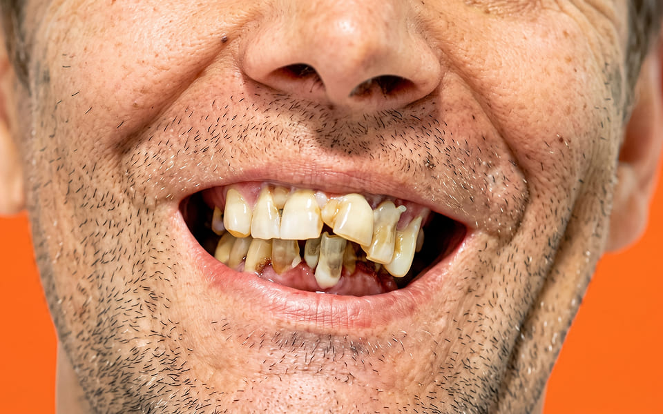 implantes-antes