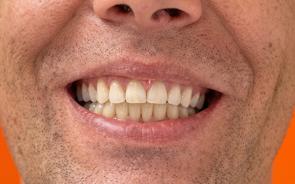 implantes-despues