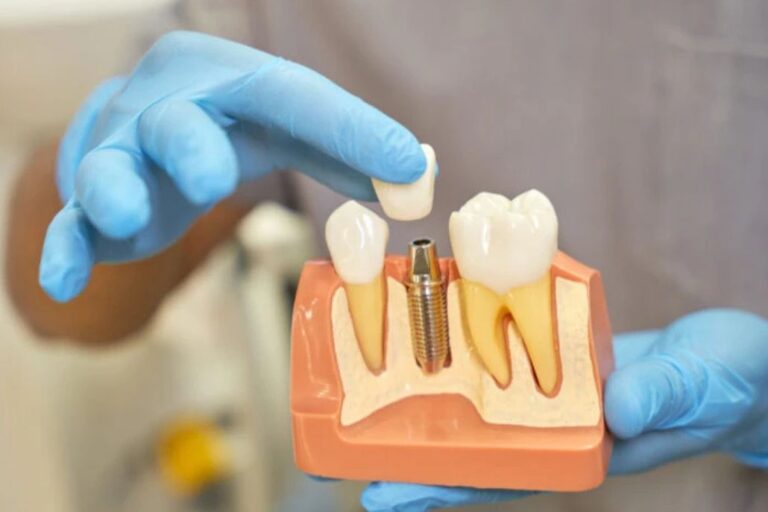 Lo que necesitas saberes de los implantes dentales