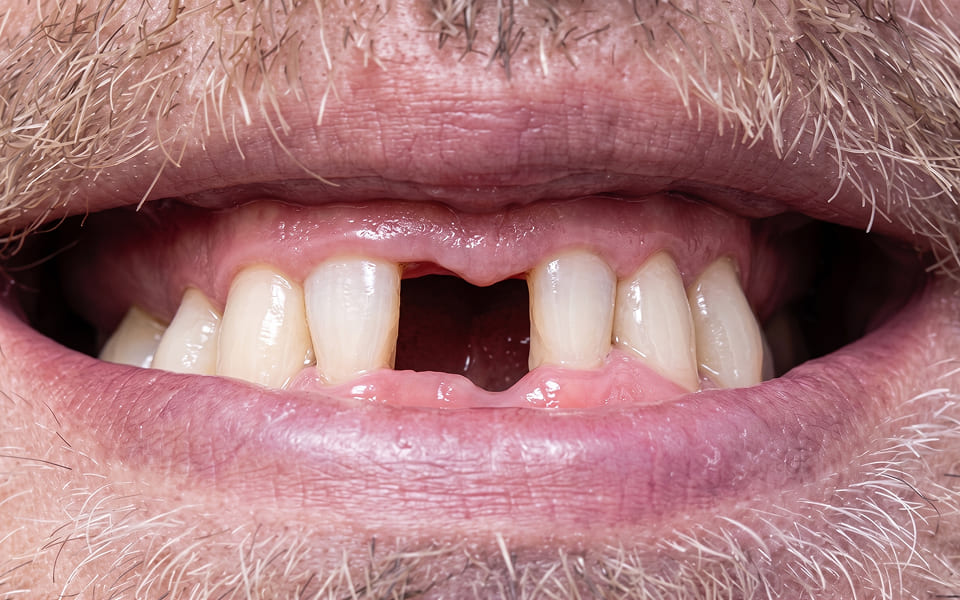 rehabilitacion-oral-antes