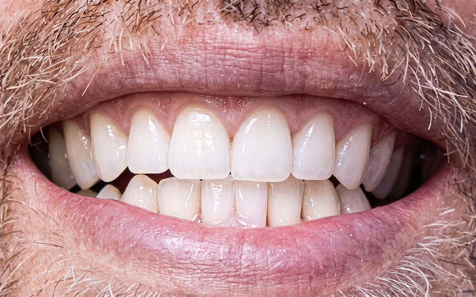 rehabilitacion-oral-despues
