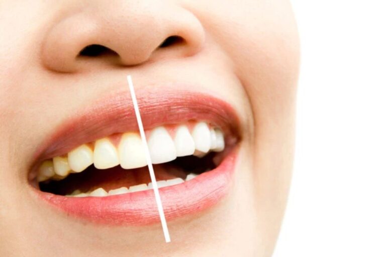 ¿Por qué los dientes cambian de color?